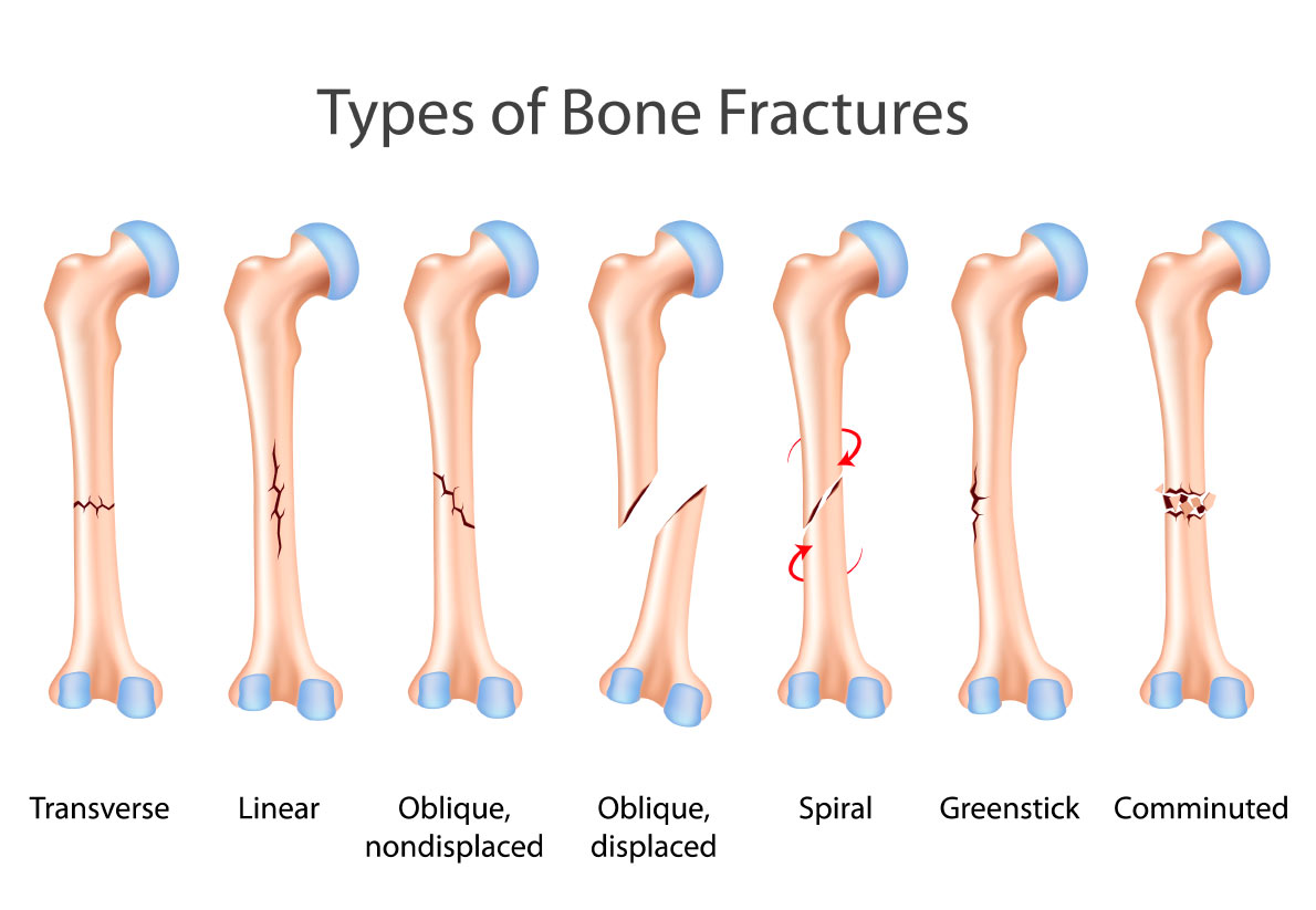 What Is The Difference Between A Fracture And A Broken Bone By Jesse 